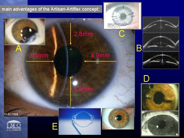 main advantages of the Artisan-Artiflex concept: 2. 8 mm A 3. 5 mm 4.