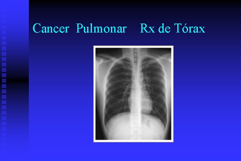 Cancer Pulmonar Rx de Tórax 