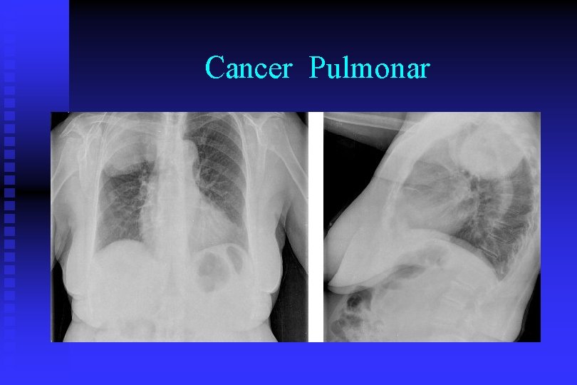 Cancer Pulmonar 