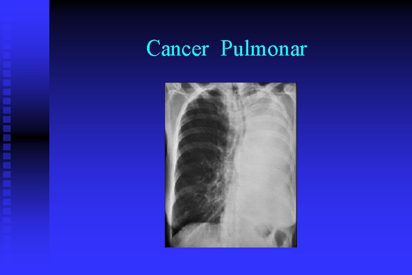 Cancer Pulmonar 