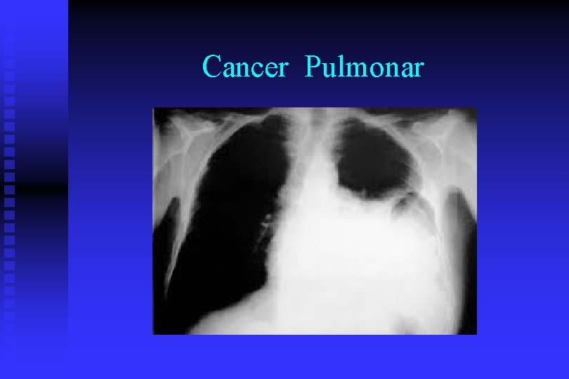 Cancer Pulmonar 