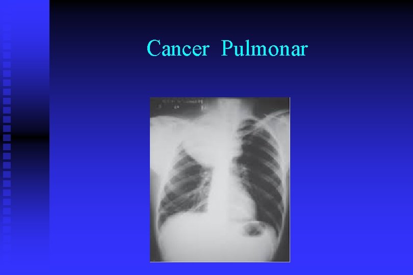 Cancer Pulmonar 