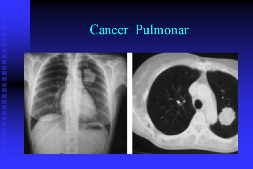 Cancer Pulmonar 