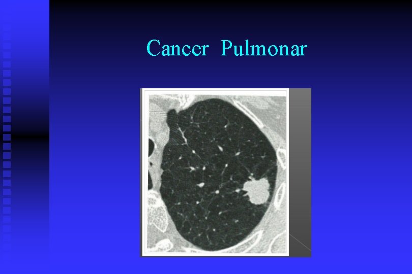 Cancer Pulmonar 