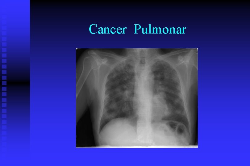 Cancer Pulmonar 