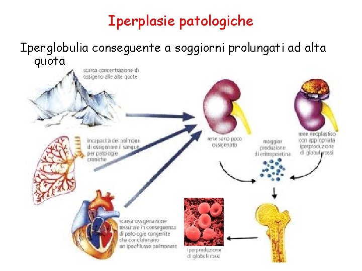 Iperplasie patologiche Iperglobulia conseguente a soggiorni prolungati ad alta quota 