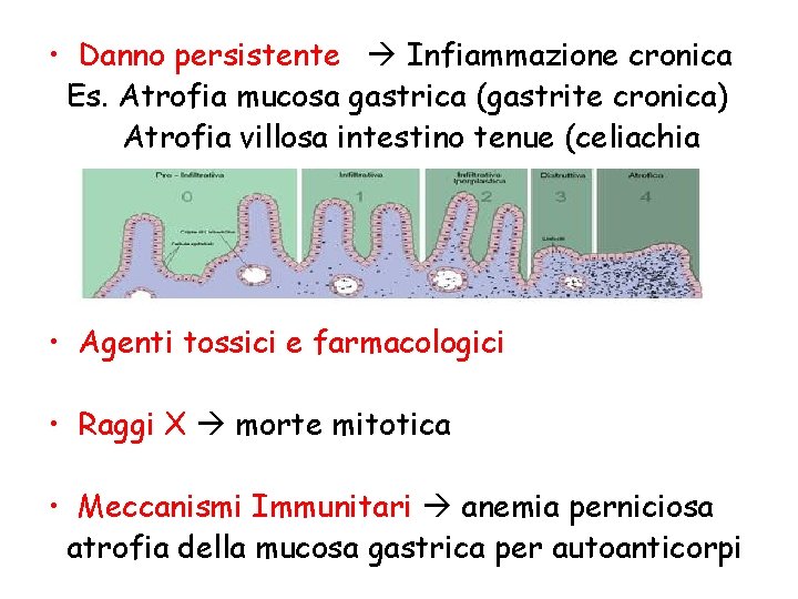  • Danno persistente Infiammazione cronica Es. Atrofia mucosa gastrica (gastrite cronica) Atrofia villosa