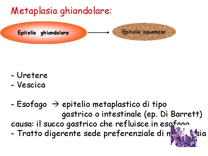 Metaplasia ghiandolare: Epitelio ghiandolare Epitelio squamoso - Uretere - Vescica - Esofago epitelio metaplastico
