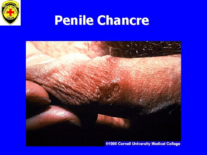 Penile Chancre 