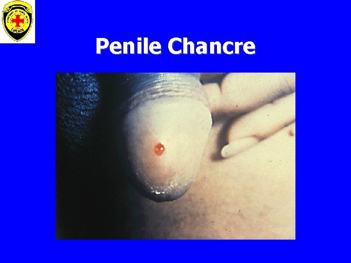 Penile Chancre 