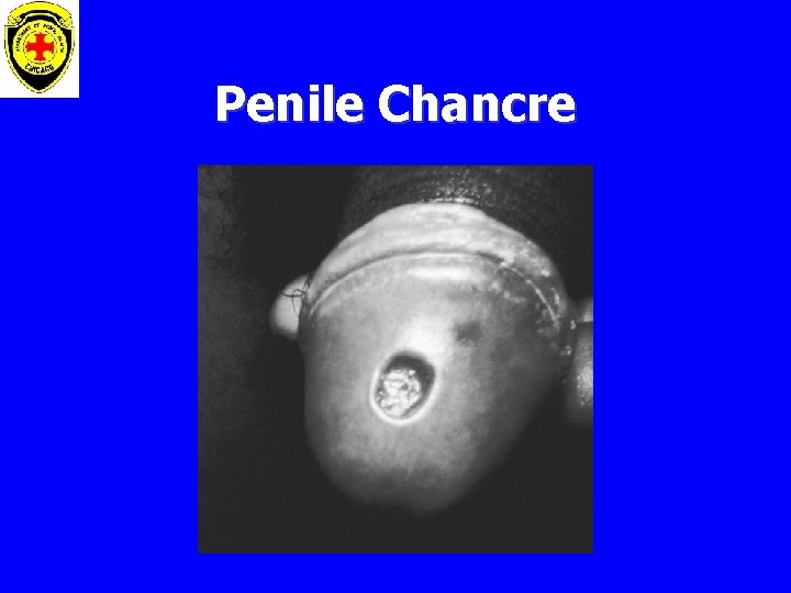 Penile Chancre 