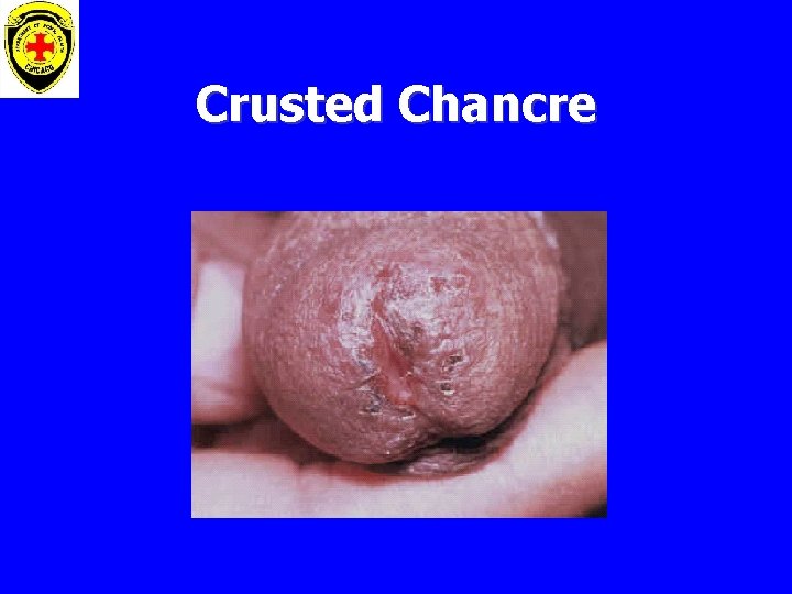 Crusted Chancre 