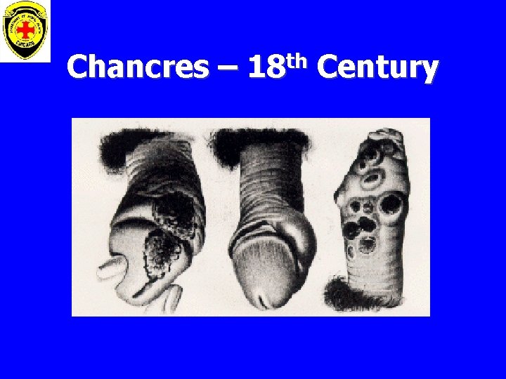 Chancres – 18 th Century 