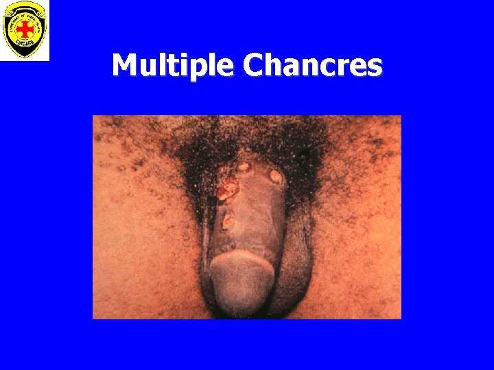 Multiple Chancres 