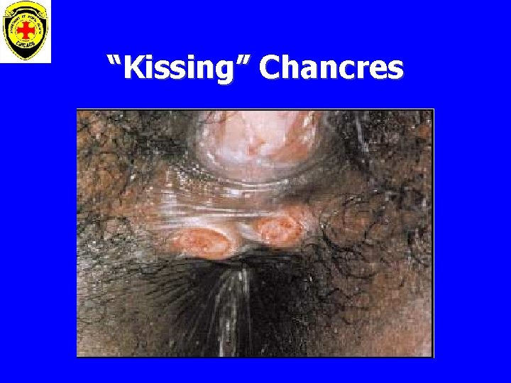 “Kissing” Chancres 