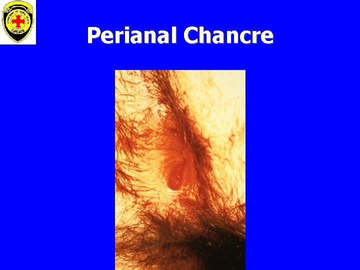 Perianal Chancre 