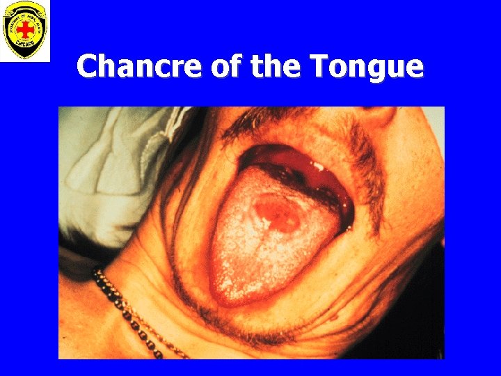 Chancre of the Tongue 