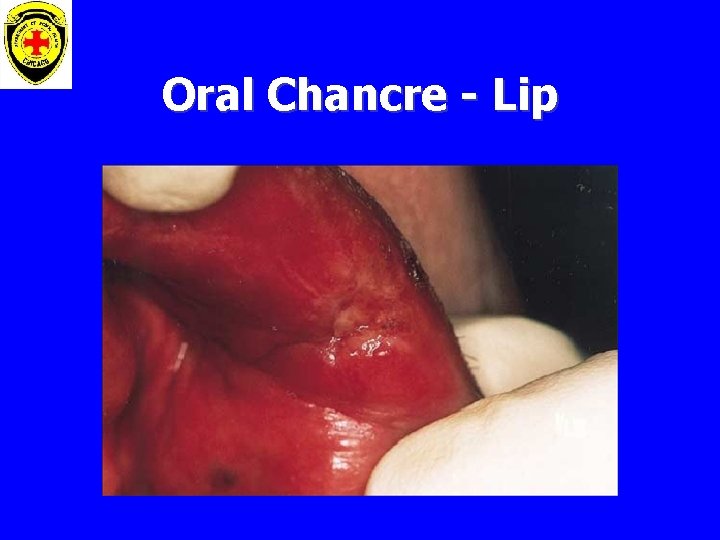 Oral Chancre - Lip 