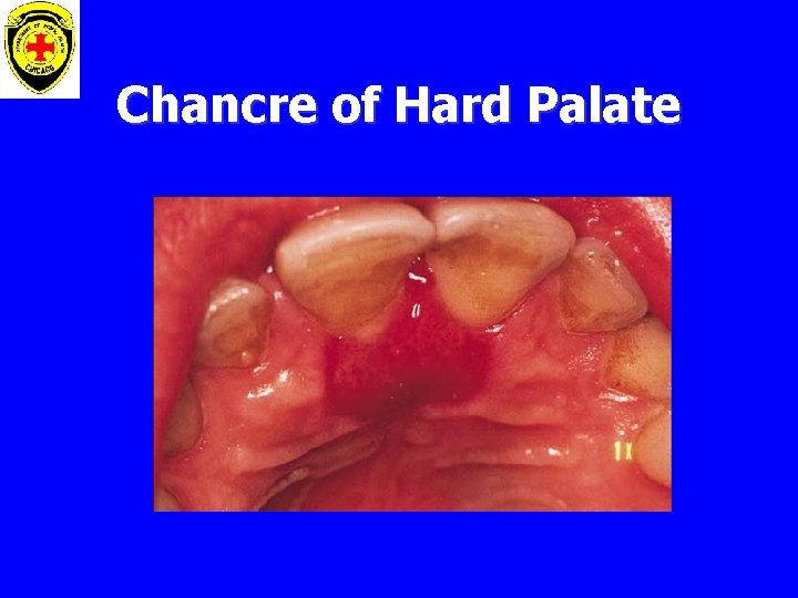 Chancre of Hard Palate 
