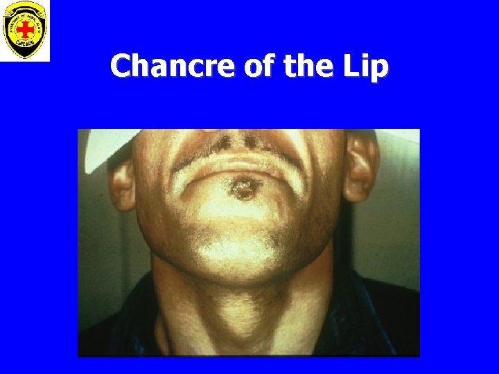 Chancre of the Lip 