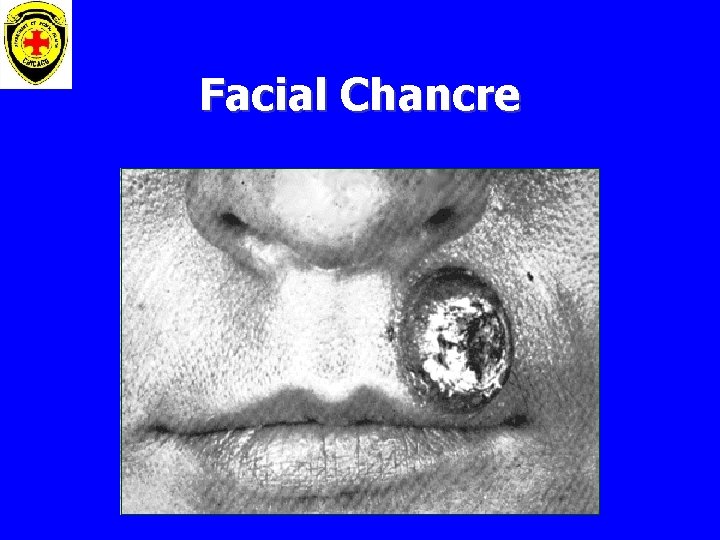 Facial Chancre 