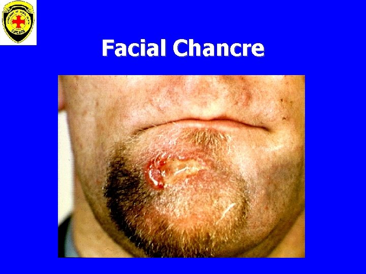 Facial Chancre 