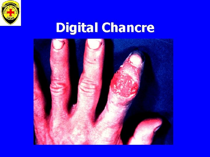 Digital Chancre 
