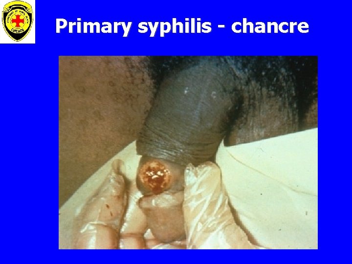 Primary syphilis - chancre 