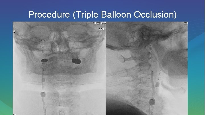 Procedure (Triple Balloon Occlusion) 