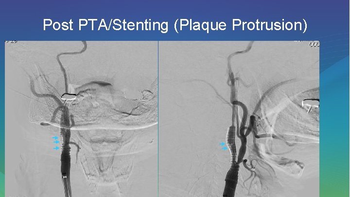 Post PTA/Stenting (Plaque Protrusion) 