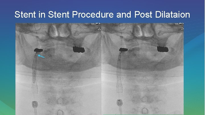 Stent in Stent Procedure and Post Dilataion 