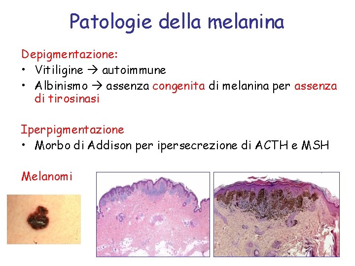 Patologie della melanina Depigmentazione: • Vitiligine autoimmune • Albinismo assenza congenita di melanina per