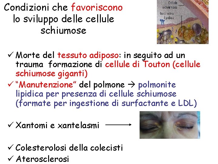 Condizioni che favoriscono lo sviluppo delle cellule schiumose ü Morte del tessuto adiposo: in