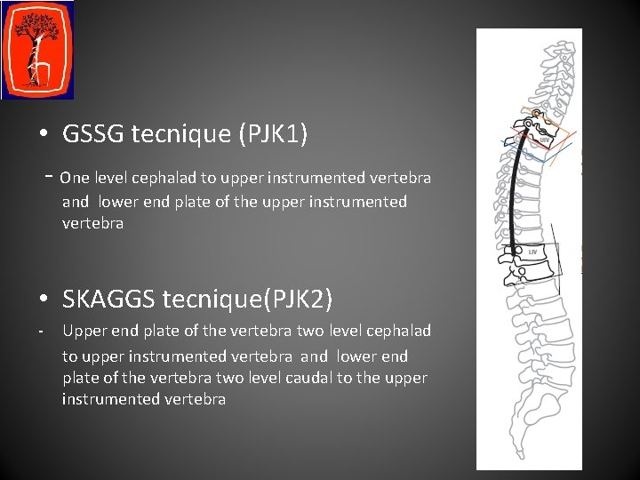  • GSSG tecnique (PJK 1) - One level cephalad to upper instrumented vertebra