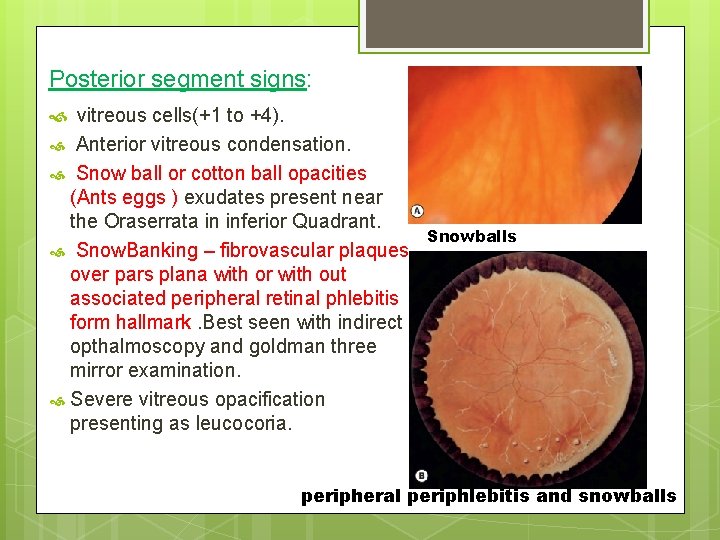 Posterior segment signs: vitreous cells(+1 to +4). Anterior vitreous condensation. Snow ball or cotton