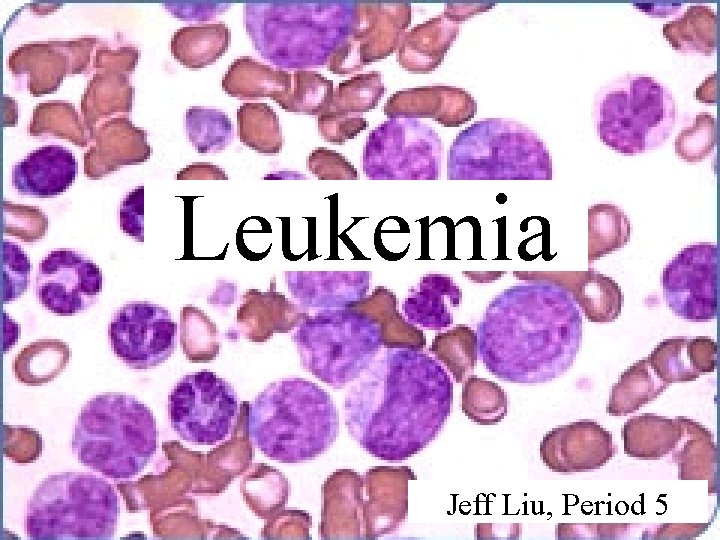 Leukemia Jeff Liu, Period 5 