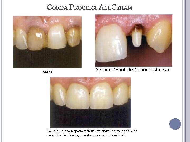 COROA PROCERA ALLCERAM Antes Preparo em forma de chanfro e sem ângulos vivos. Depois,