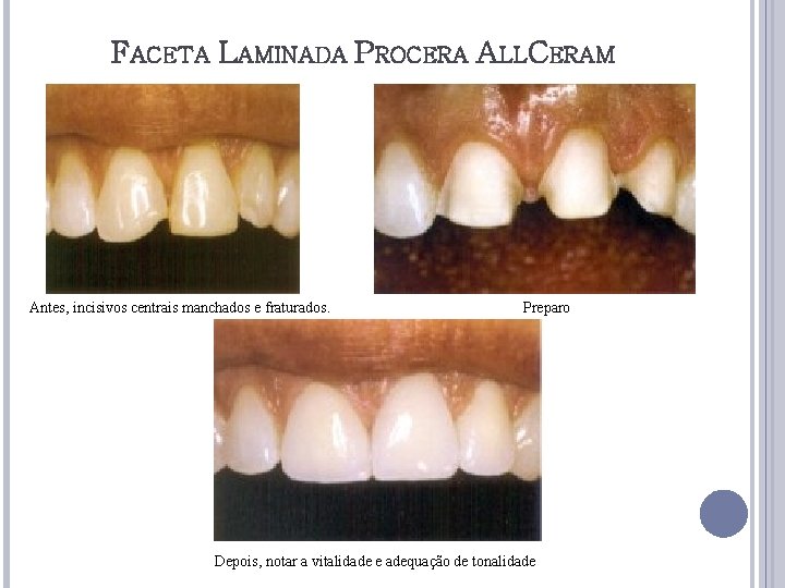 FACETA LAMINADA PROCERA ALLCERAM Antes, incisivos centrais manchados e fraturados. Preparo Depois, notar a