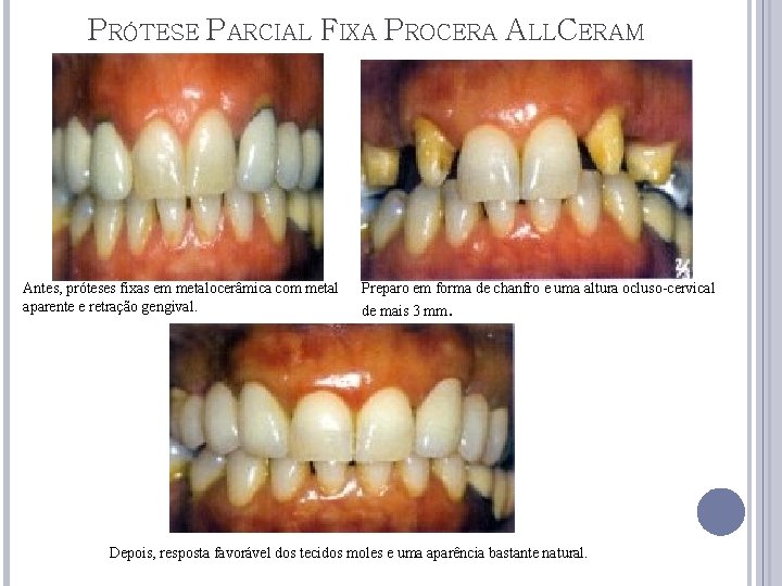 PRÓTESE PARCIAL FIXA PROCERA ALLCERAM Antes, próteses fixas em metalocerâmica com metal aparente e