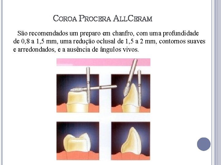 COROA PROCERA ALLCERAM São recomendados um preparo em chanfro, com uma profundidade de 0,