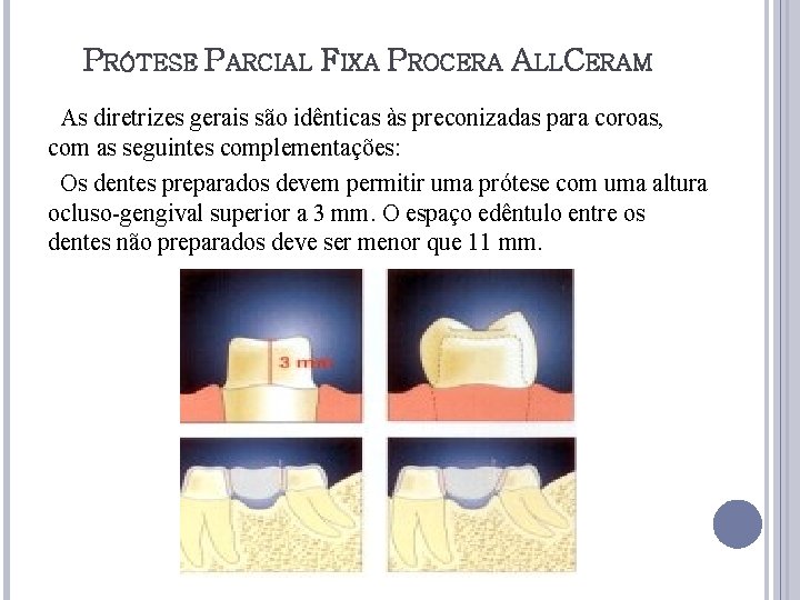 PRÓTESE PARCIAL FIXA PROCERA ALLCERAM As diretrizes gerais são idênticas às preconizadas para coroas,