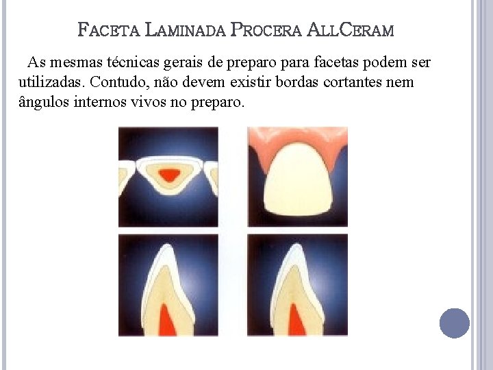 FACETA LAMINADA PROCERA ALLCERAM As mesmas técnicas gerais de preparo para facetas podem ser