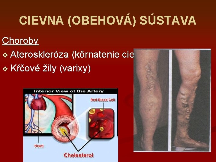 CIEVNA (OBEHOVÁ) SÚSTAVA Choroby v Ateroskleróza (kôrnatenie ciev) v Kŕčové žily (varixy) 