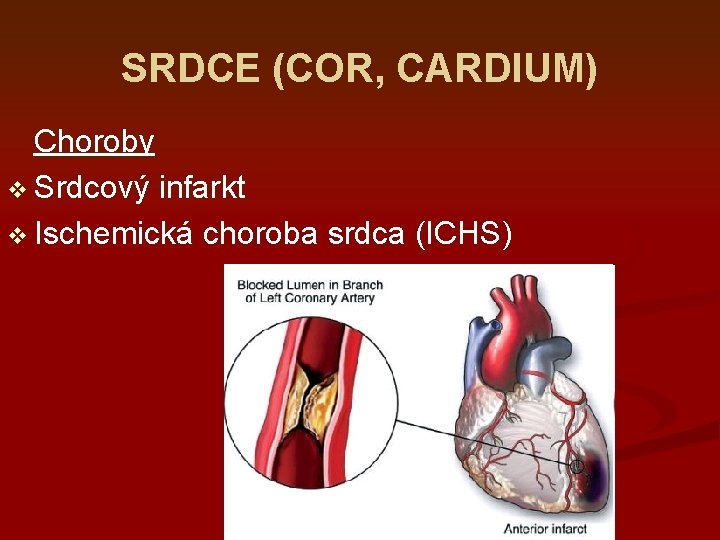 SRDCE (COR, CARDIUM) Choroby v Srdcový infarkt v Ischemická choroba srdca (ICHS) 