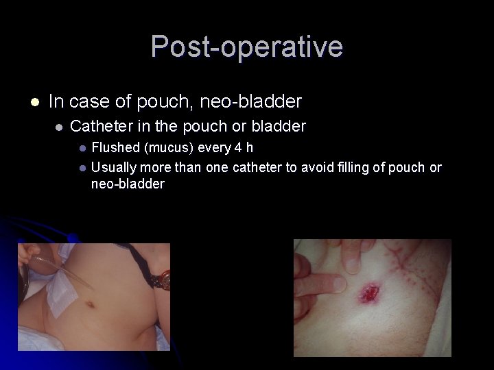 Post-operative l In case of pouch, neo-bladder l Catheter in the pouch or bladder