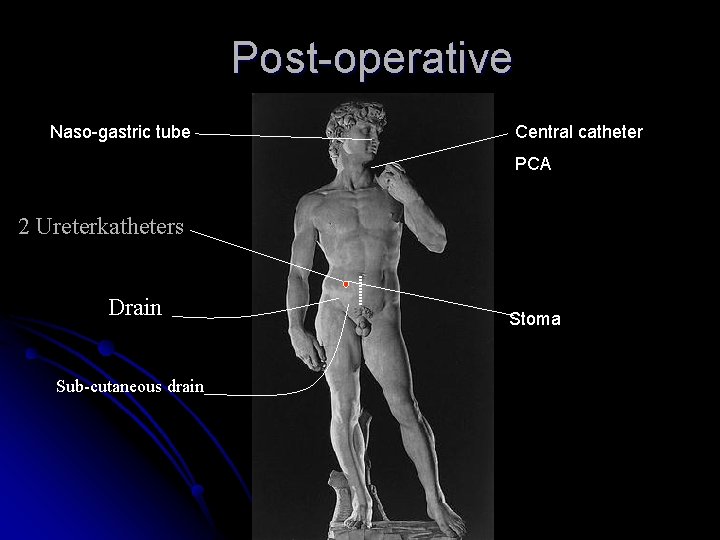 Post-operative Naso-gastric tube Central catheter PCA 2 Ureterkatheters Drain Sub-cutaneous drain Stoma 