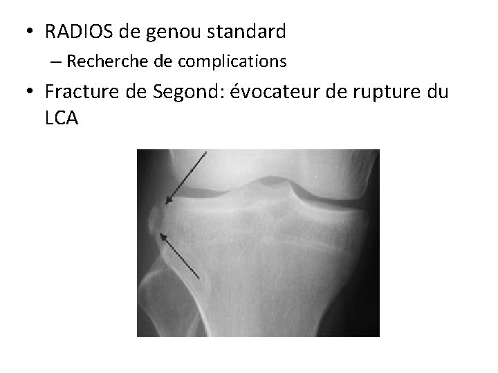  • RADIOS de genou standard – Recherche de complications • Fracture de Segond: