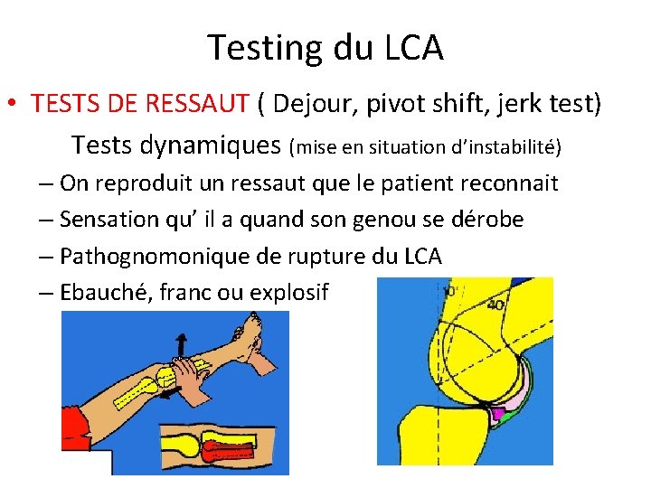 Testing du LCA • TESTS DE RESSAUT ( Dejour, pivot shift, jerk test) Tests