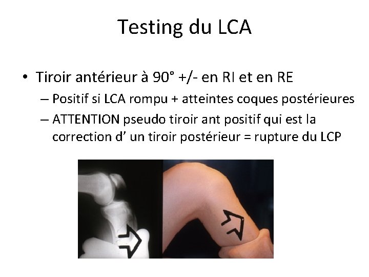 Testing du LCA • Tiroir antérieur à 90° +/- en RI et en RE