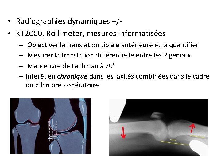  • Radiographies dynamiques +/ • KT 2000, Rollimeter, mesures informatisées – – Objectiver